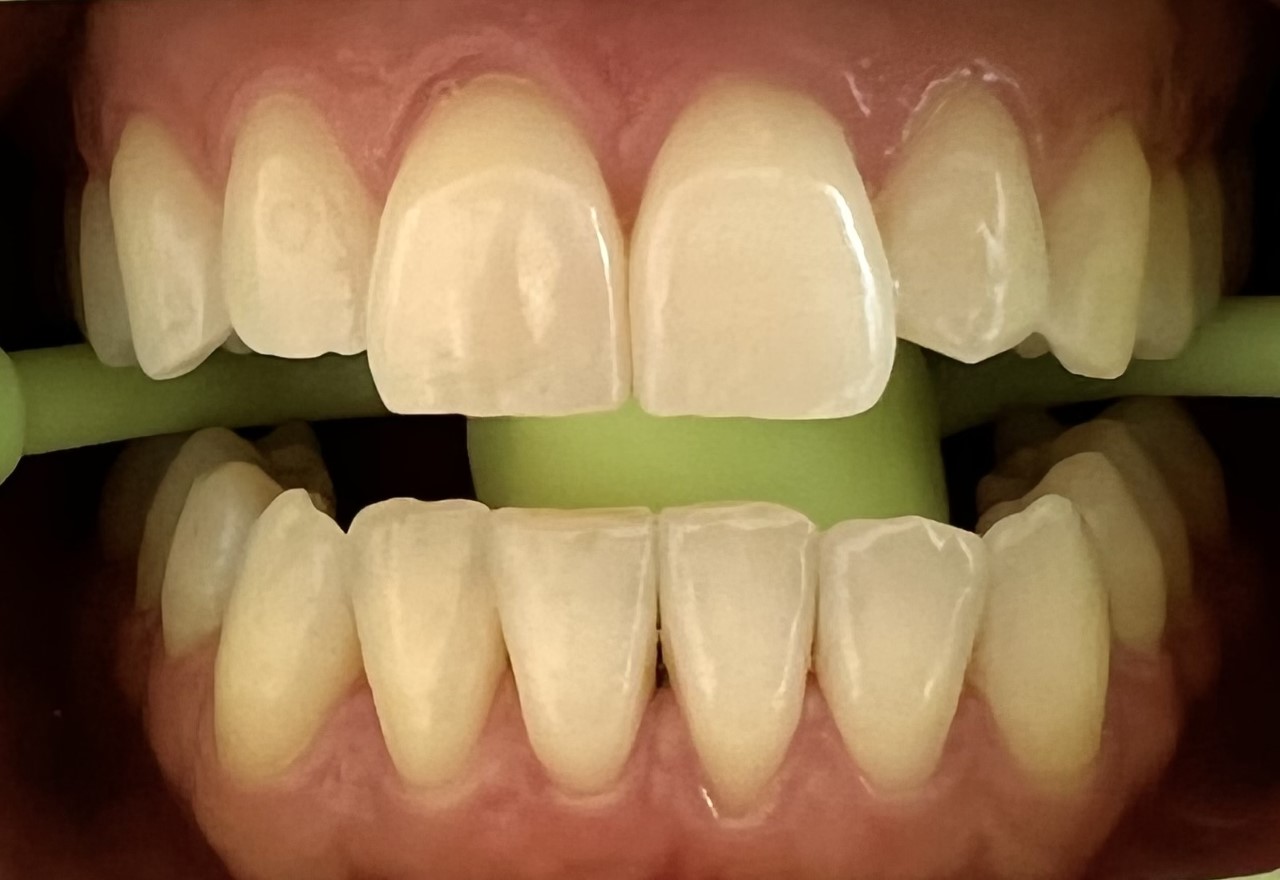yellow teeth before 