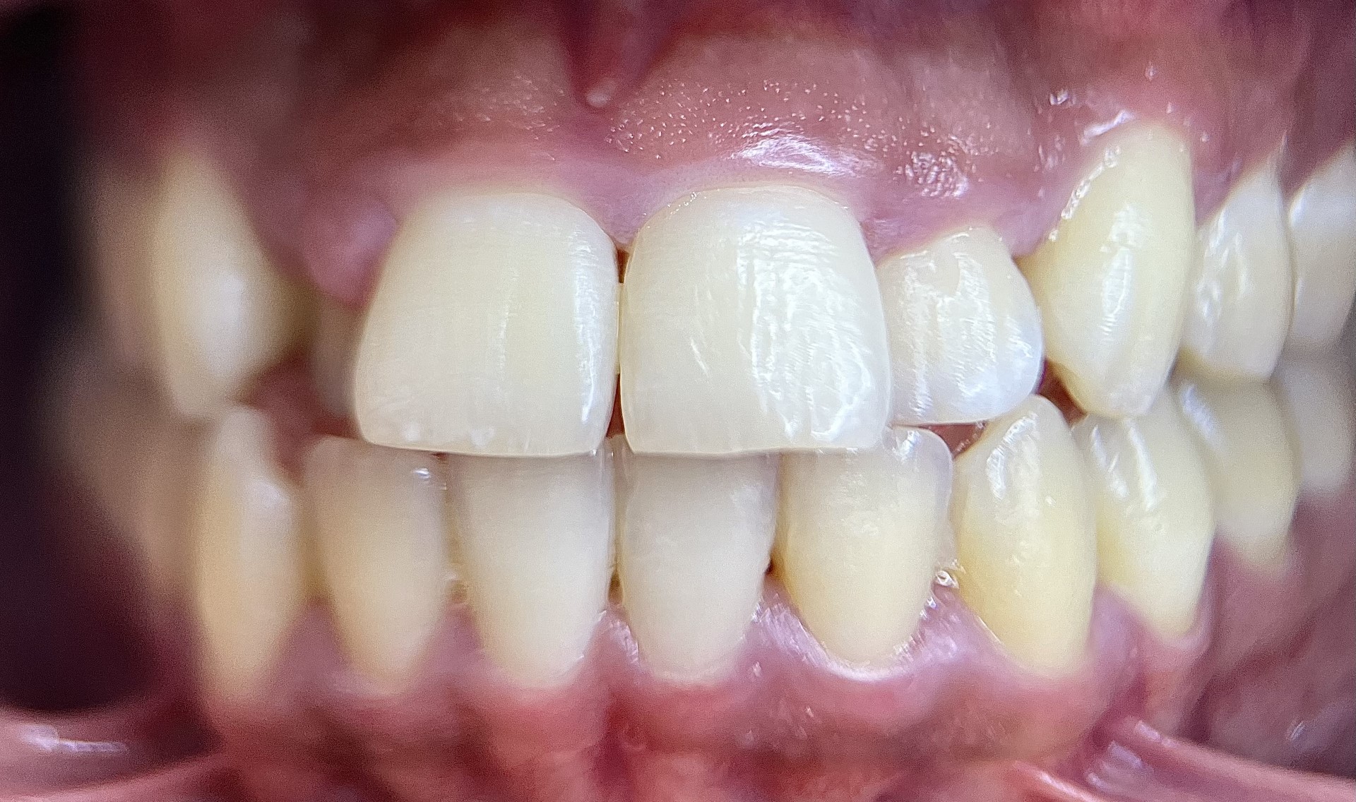 healthy gums after treatments