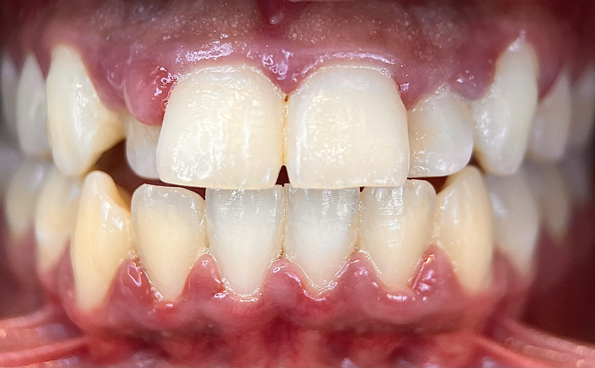 Gingivitis puffy swollen gums with poor plaque removal bleeding gums