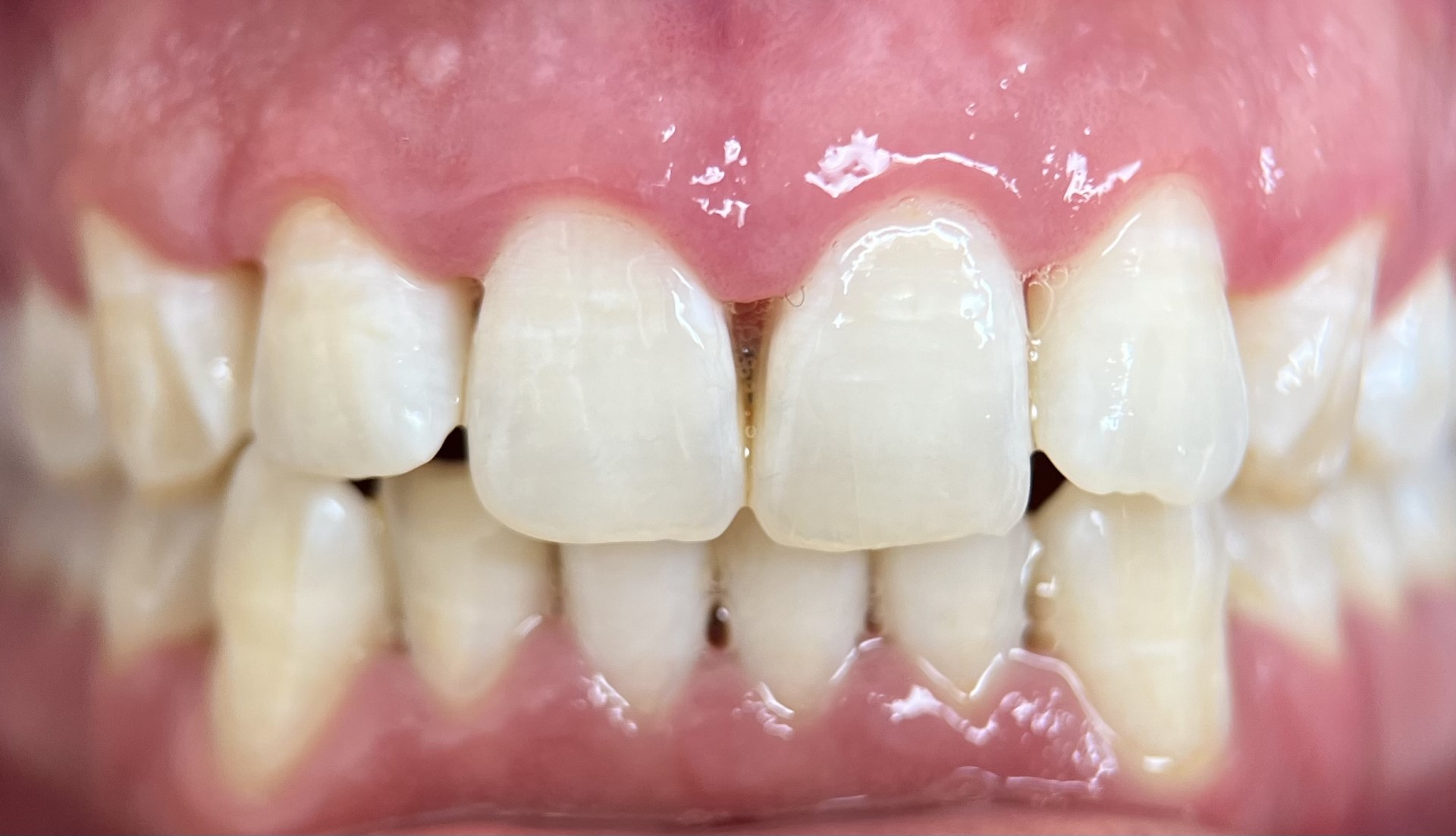 healthy gums after treatments