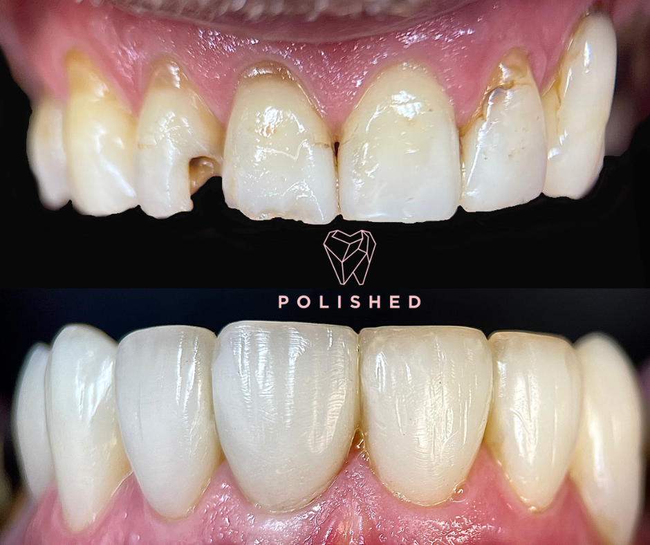 composite veneers