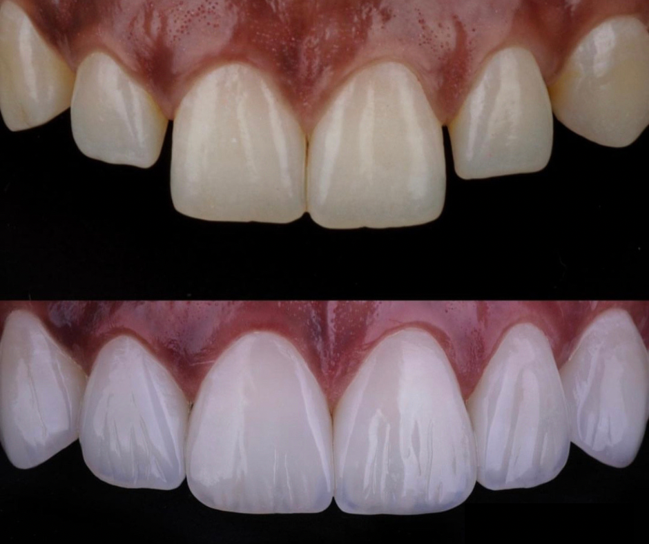 composite bonding