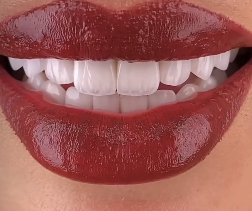 composite veneers