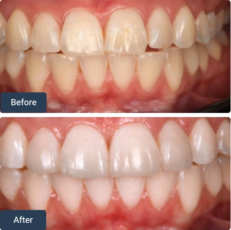 composite bonding