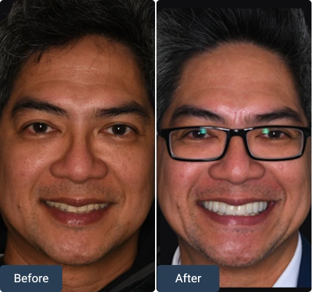 composite bonding