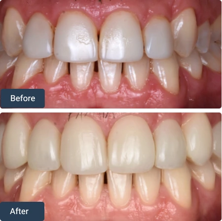 composite bonding
