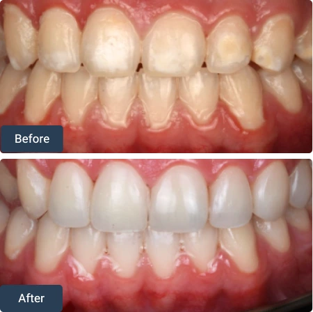 composite bonding