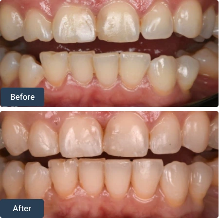 composite bonding